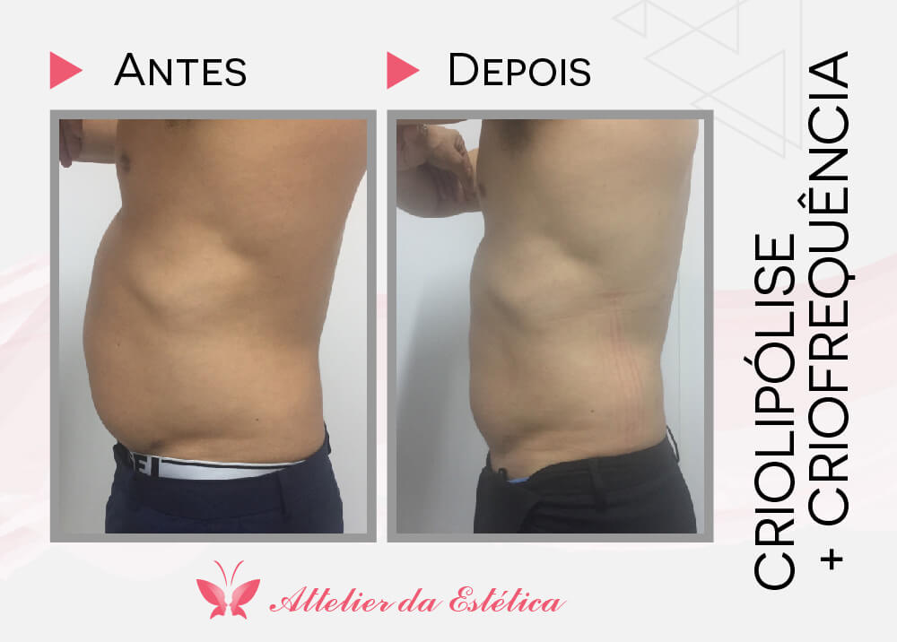 antes e depois criofrequencia gordura na barriga